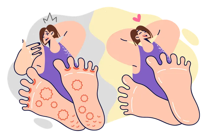 Woman With Foot Fungus Before And After Using Medicinal Ointment Or Seeing Doctor Girl Who Has Recovered From Foot Fungus Or Allergic Rash Experiences Happiness And Relief Thanks To Medications Illustration