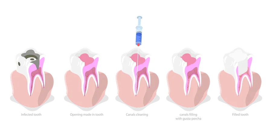 Wurzelbehandlung  Illustration