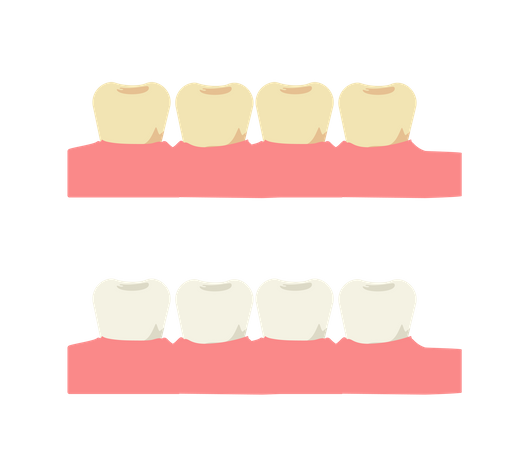Zahnaufhellung und Zahn mit gelbem Belag vor  Illustration