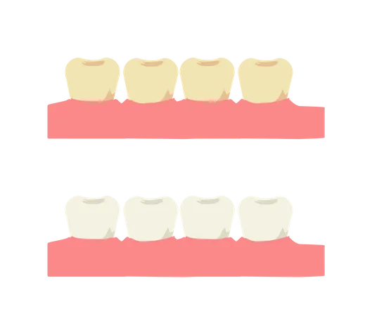 Zahnaufhellung und Zahn mit gelbem Belag vor  Illustration